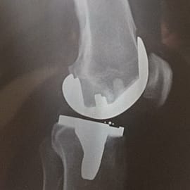 total knee replacement surgery in Germany