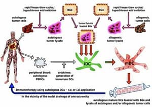 dendritic cell vaccination for cancer in Germany