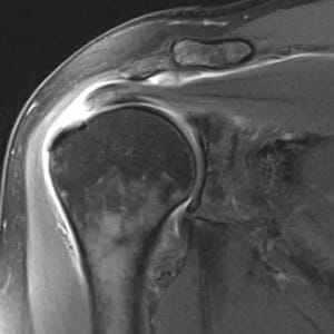 shoulder rotator cuff torn surgery in Germany