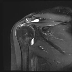 Rotator_cuff_tear