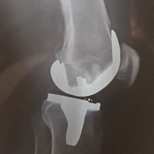 total knee replacement surgery in German