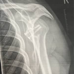 Shoulder surgery