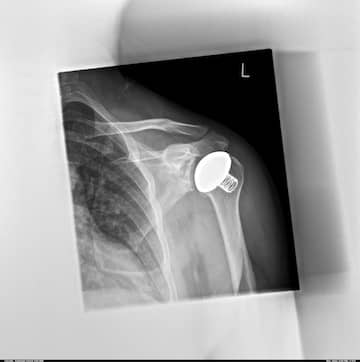 shoulder endoprosthesis in Germany