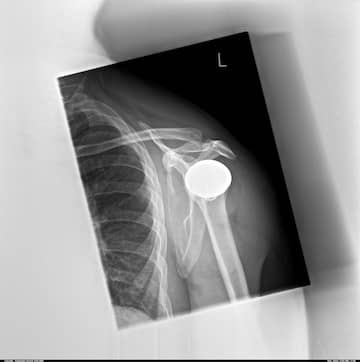 shoulder total endoprosthesis in Germany